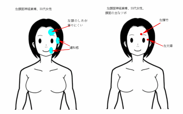 左顔面神経麻痺（１）症状・つぼ